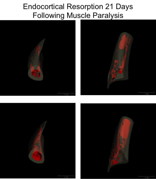 Assessing focal alterations in bone morphology via temporal microCT